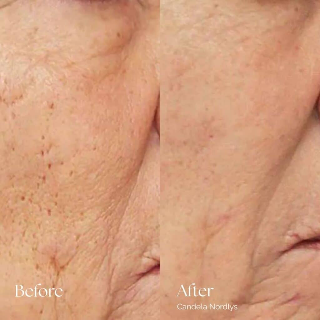 Candela Nordlys Before and After