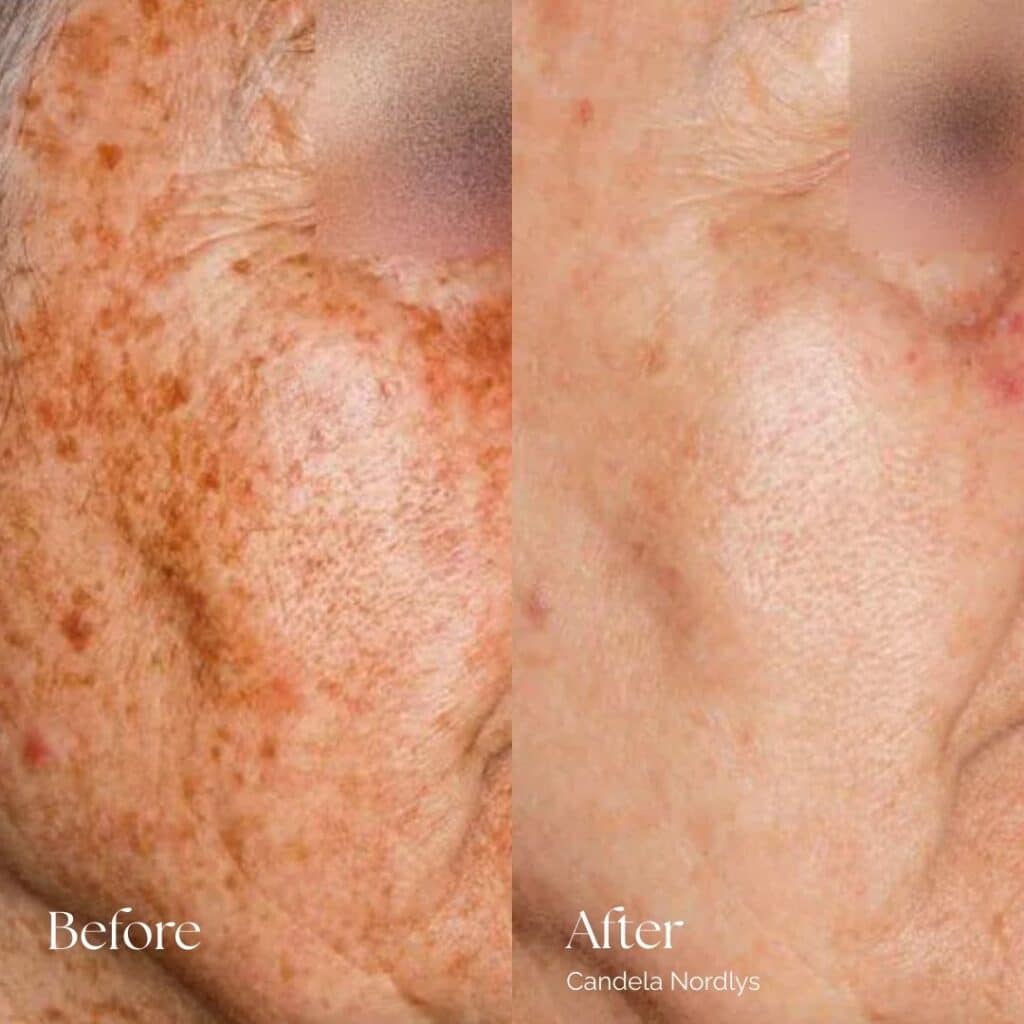 Candela Nordlys Before and After