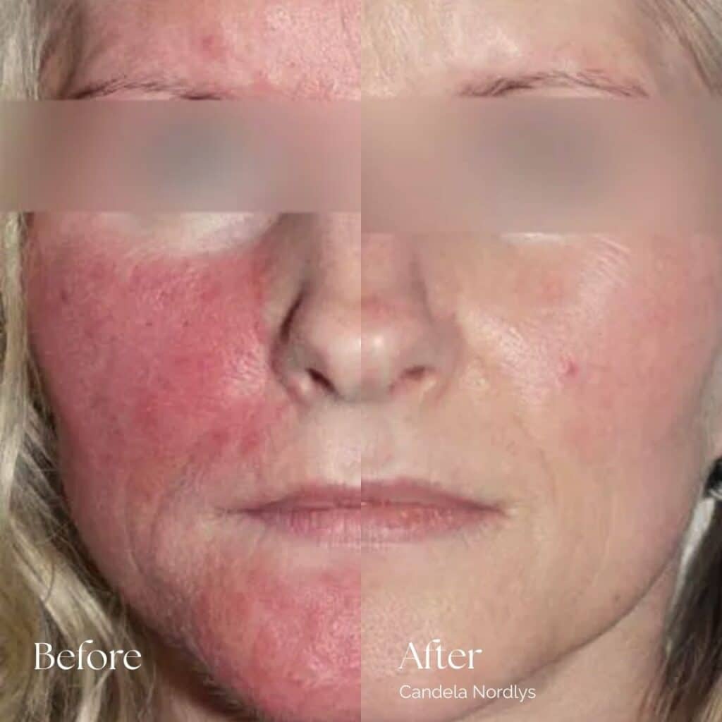 Candela Nordlys Before and After