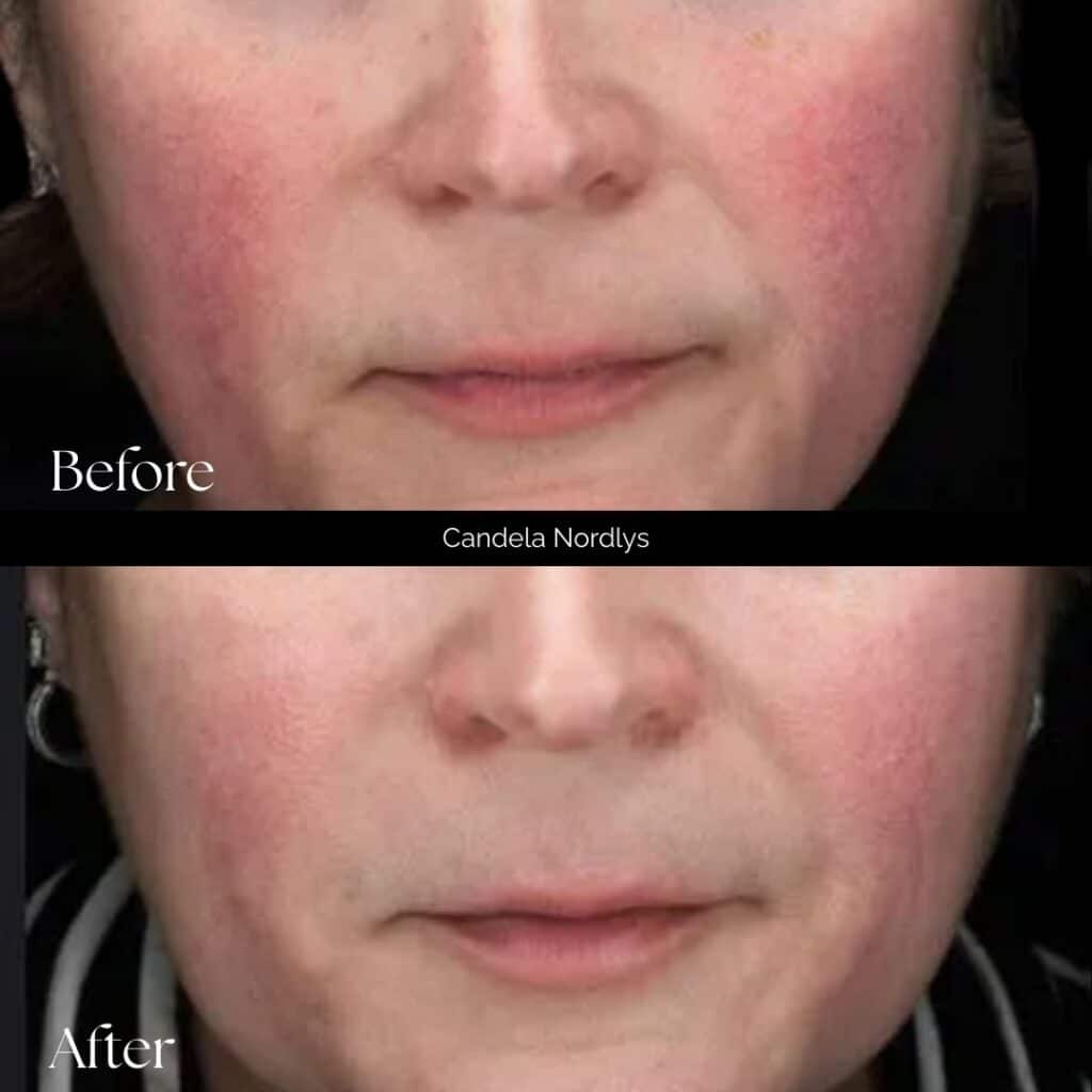 Candela Nordlys Before and After