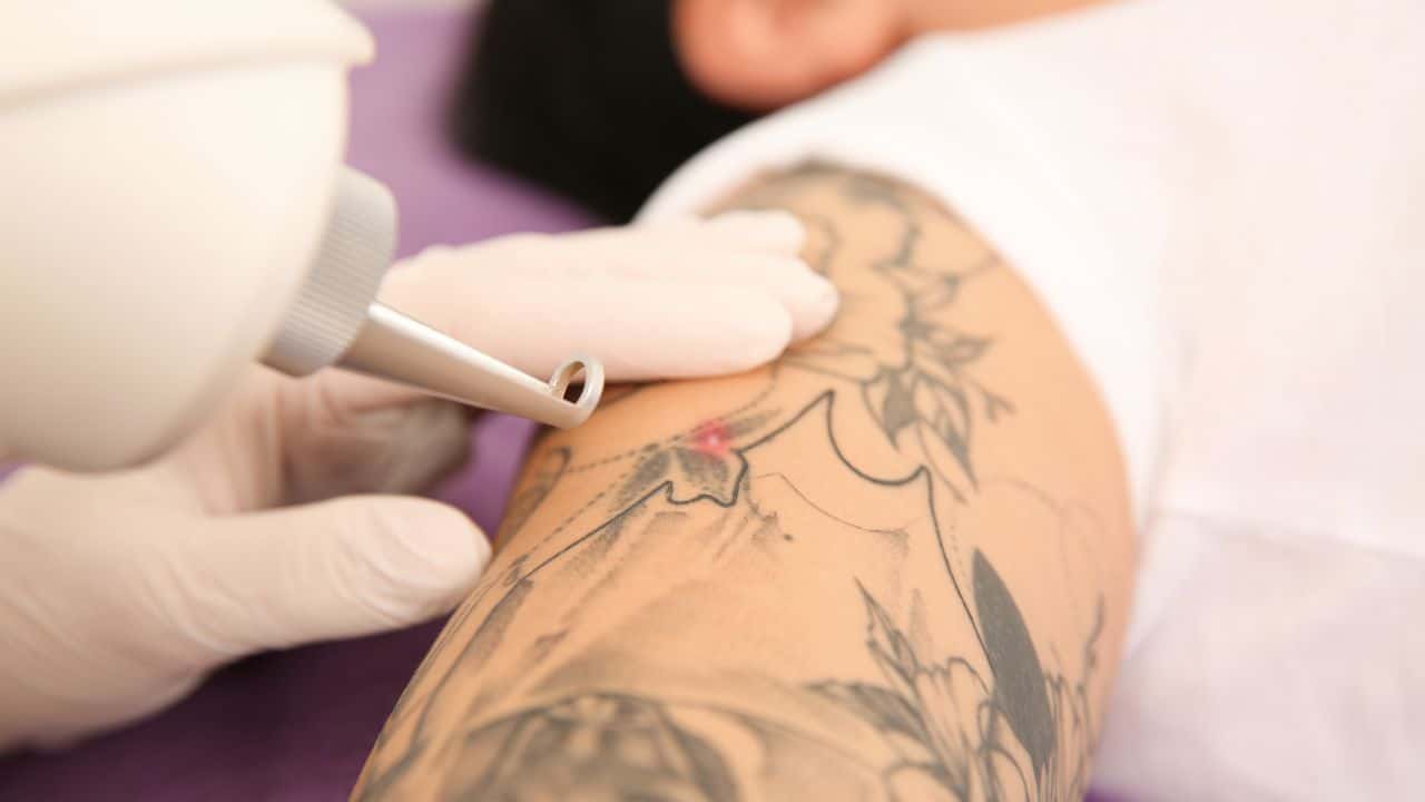 Tattoo Removal Treatments
