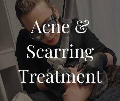 Acne & Scarring Treatment in Moncton 1 Acne & Scarring Treatment Moncton Sparkle MediSpa