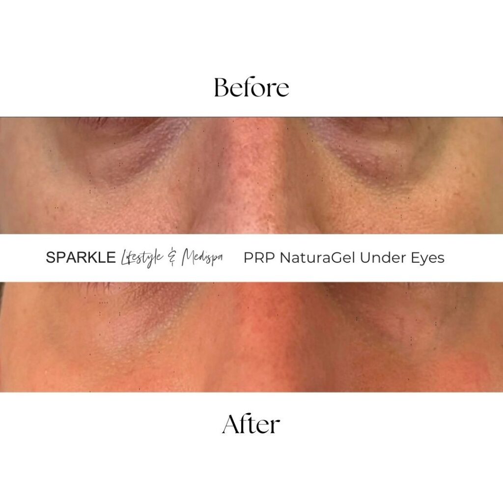 Before & After PRP NaturaGel Undereye treatment moncton