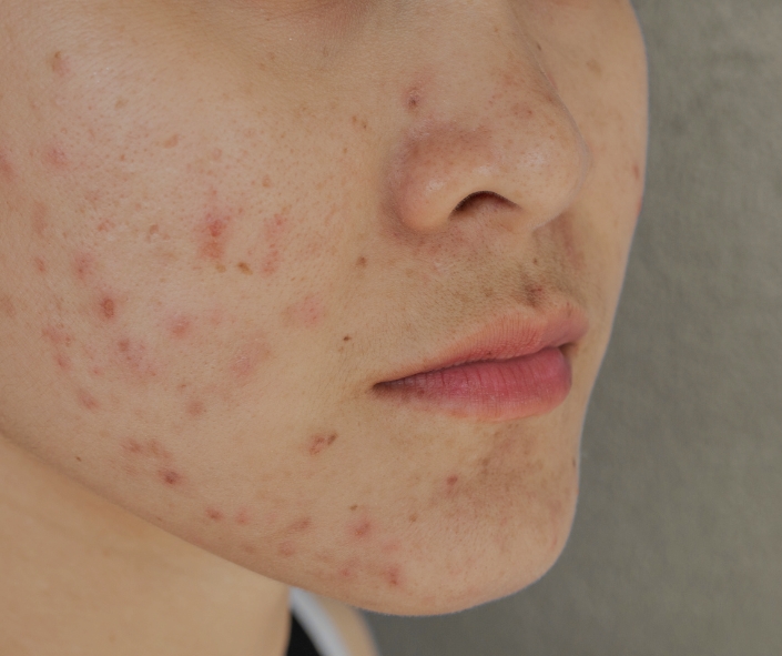 Best Acne Treatment Moncton | Clear Skin 1 Best Acne & Scarring Treatment Moncton