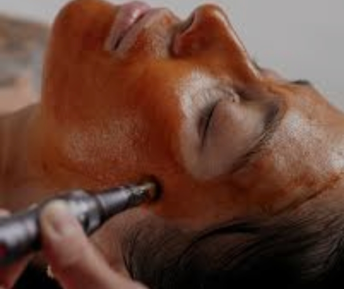 Best Osmosis Medi Infusion Moncton 1 Best Osmosis RevitaPen Facial Moncton