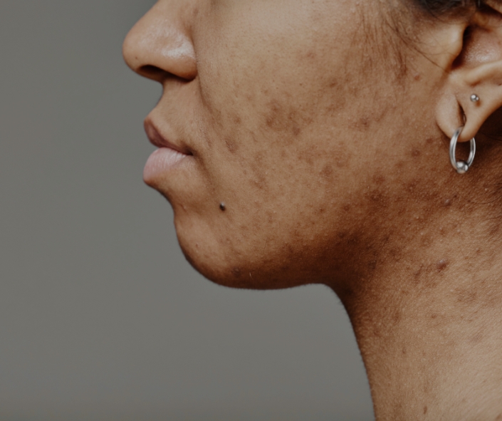 Best PRP for Acne Scars Moncton 1 Best PRP for Acne Scars Moncton