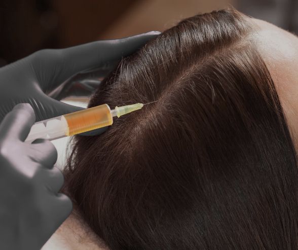 PRP for Hair Loss Moncton 1 Hair Loss Treatment in Moncton Sparkle MediSpa