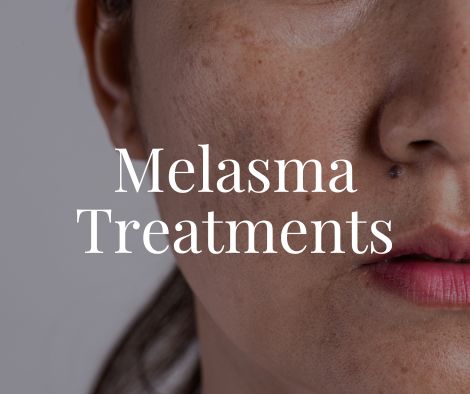 Melasma 1 Melasma Treatment Moncton NB Sparkle MediSpa
