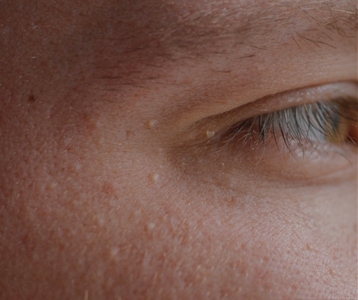 Best Milia Removal Moncton 1 Milia Removal Treatment