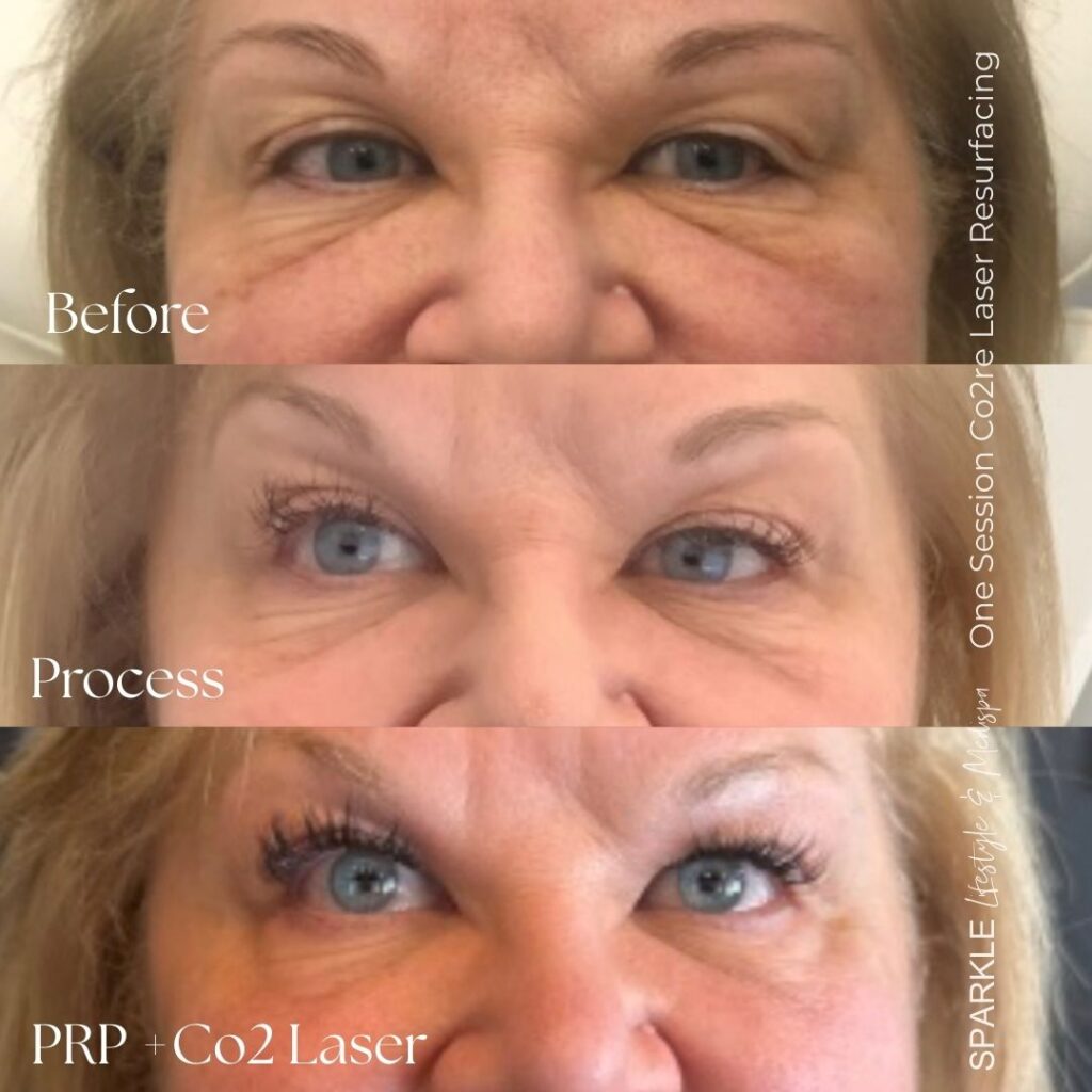 Before & After PRP NaturaGel Undereye treatment moncton