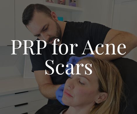 PRP for Acne Scars 1 PRP for Acne Scars