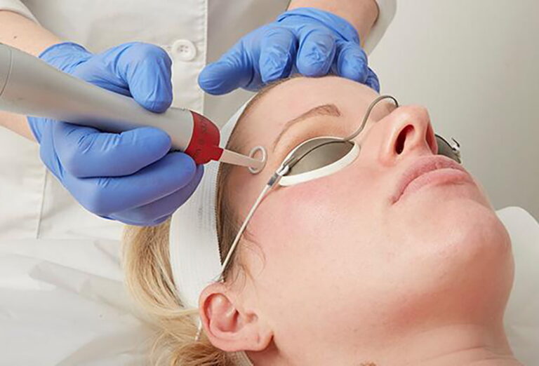 PicoWay Laser Treatment Process Moncton NB