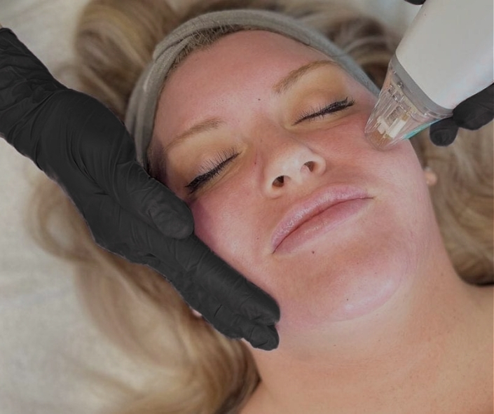 Classic & RF Microneedling Moncton 1 Potenza RF Microneedling 2