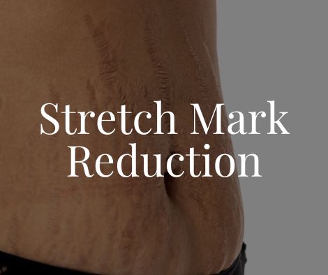 Stretch Mark Reduction 1 Stretch Mark Reduction Moncton NB
