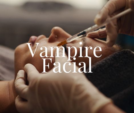 PRP Treatment in Moncton 4 Vampire Facial Treatment Moncton NB