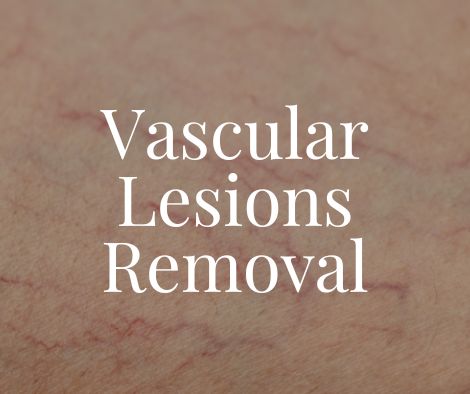 Vascular Lesions Removal 1 Vascular Lesions Removal Treatment Moncton NB Sparkle MediSpa