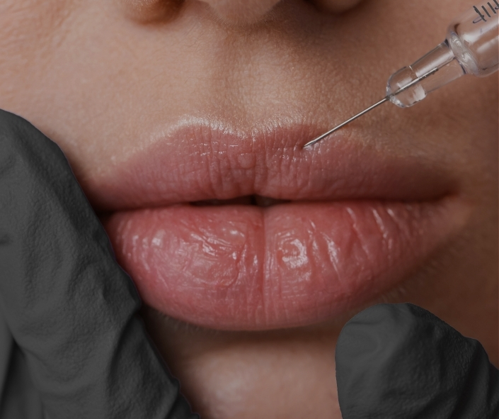 Lip Botox 1 Whats a lip Flip Moncton NB Sparkle MediSpa (2)