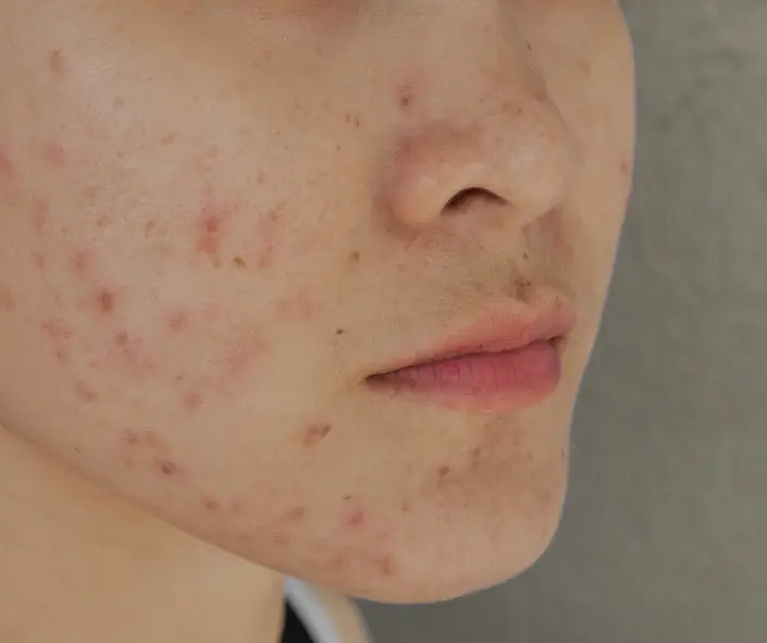 Best Acne & Scarring Treatment Moncton