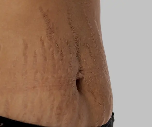 Best Laser Stretch Mark Reduction Moncton & Dieppe
