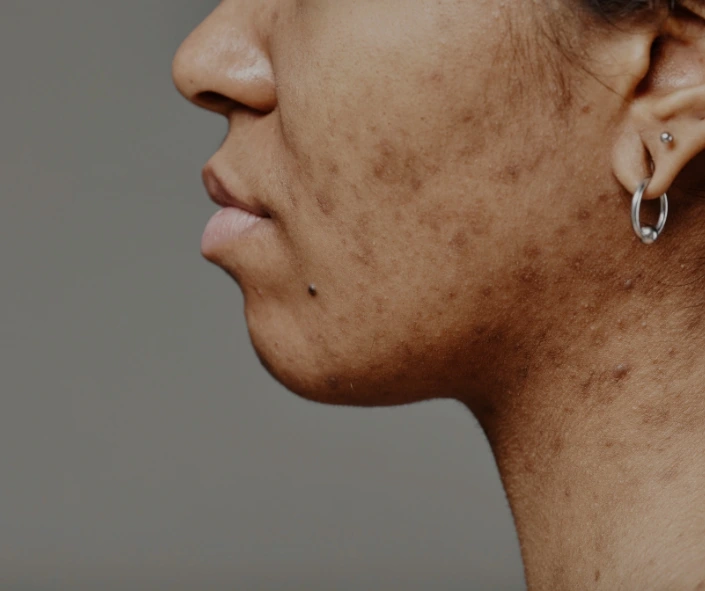 Best PRP for Acne Scars Moncton