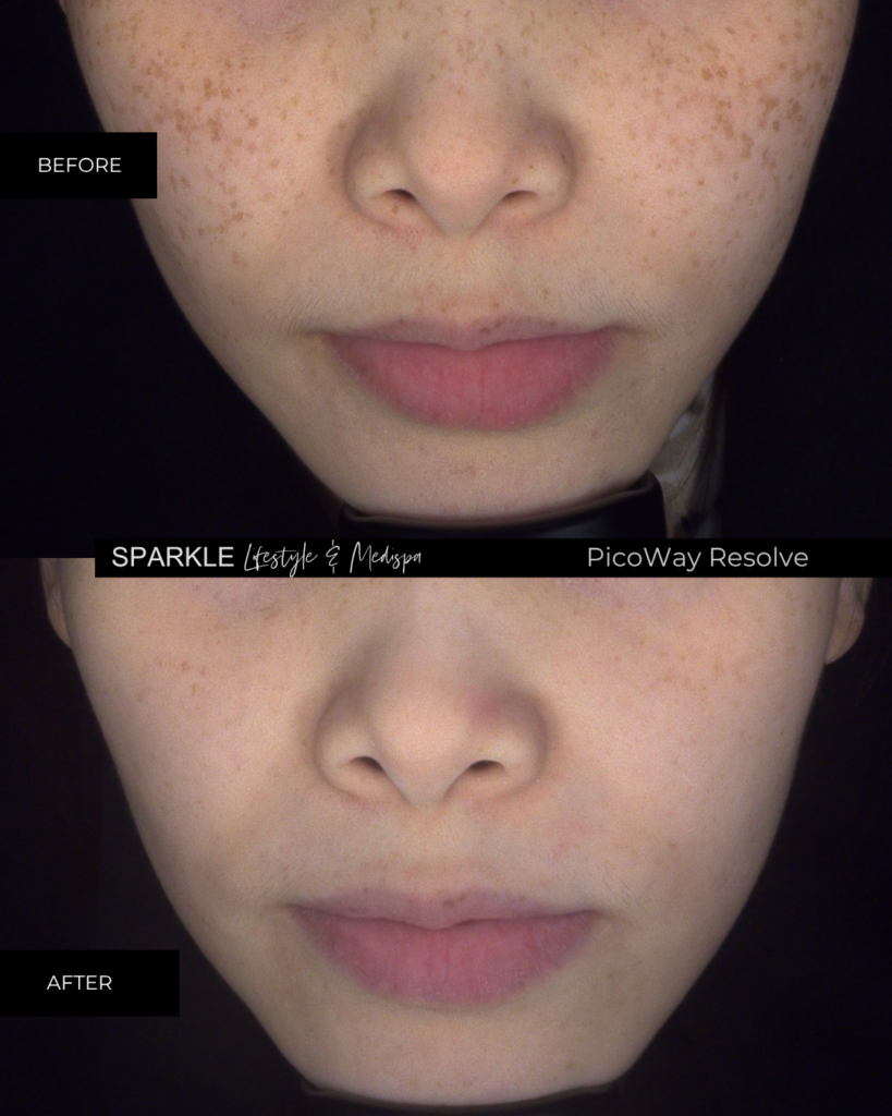 PicoWay Resolve Before and After for Pigmentation