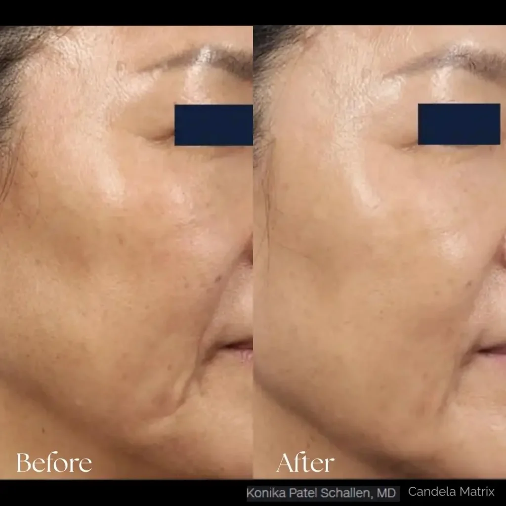 Matrix Pro RF Microneedling Before After Results Moncton NB