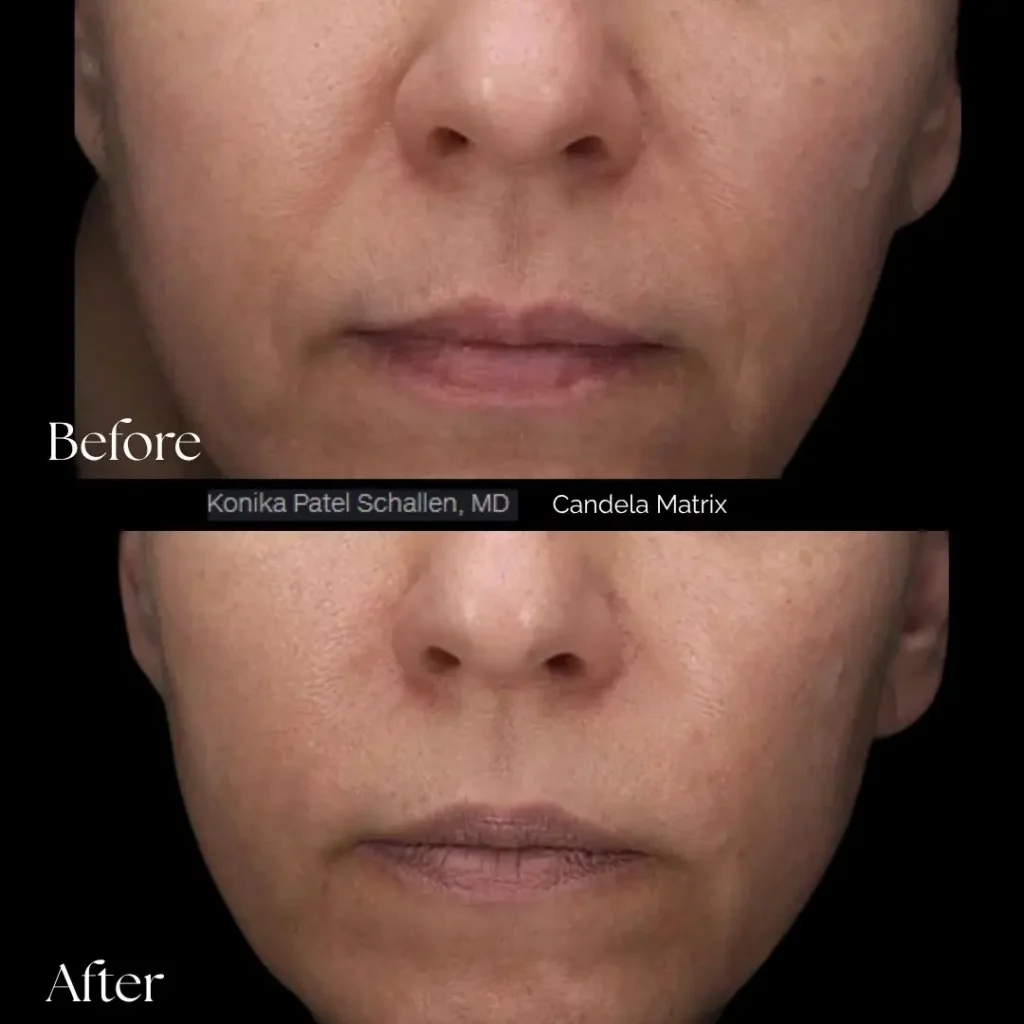Matrix Pro RF Microneedling 2 Matrix Pro RF Microneedling Before After Results Moncton NB (2)