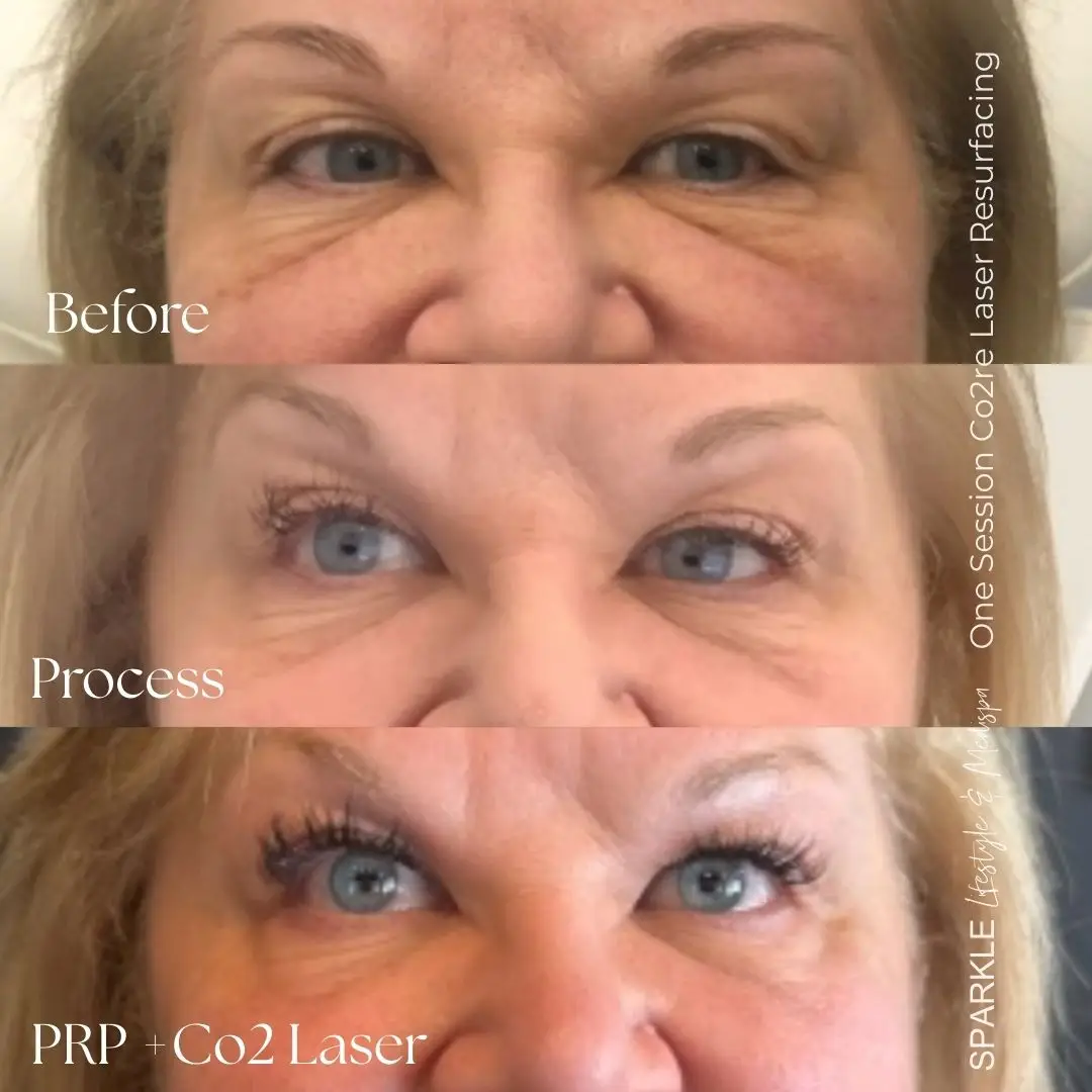 Best PRP Treatment Moncton 5 Before & After PRP NaturaGel Undereye treatment moncton