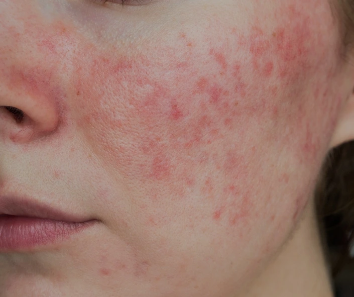 Redness & Rosacea treatment Moncton NB Sparkle MediSpa