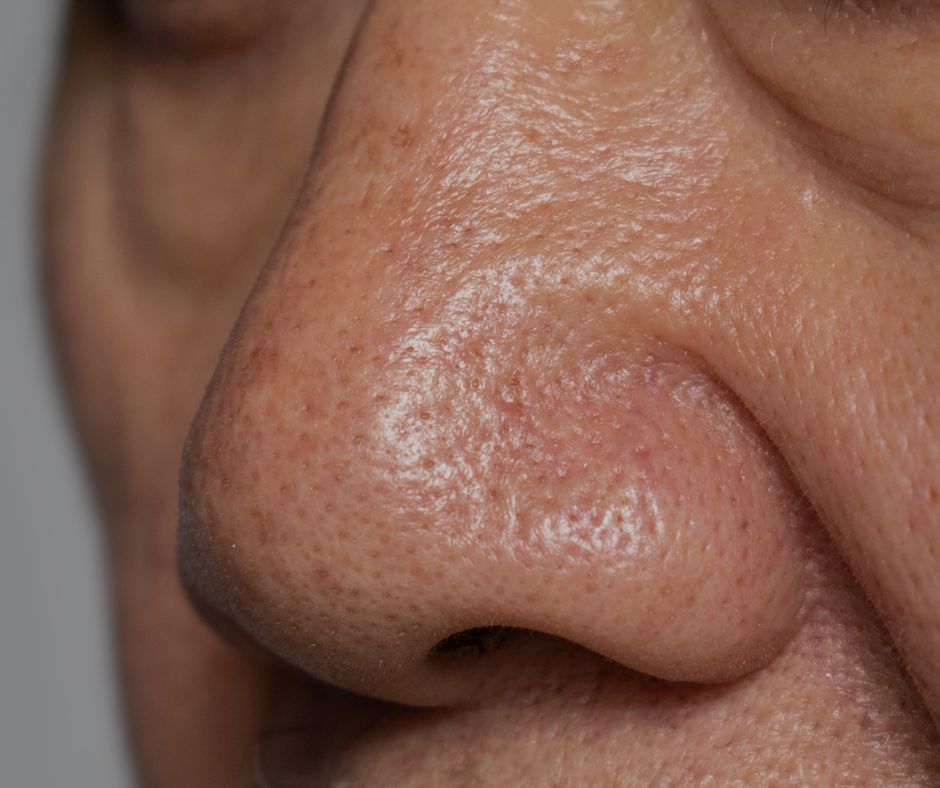Enlarged Pore Treatment in Moncton & Dieppe.
