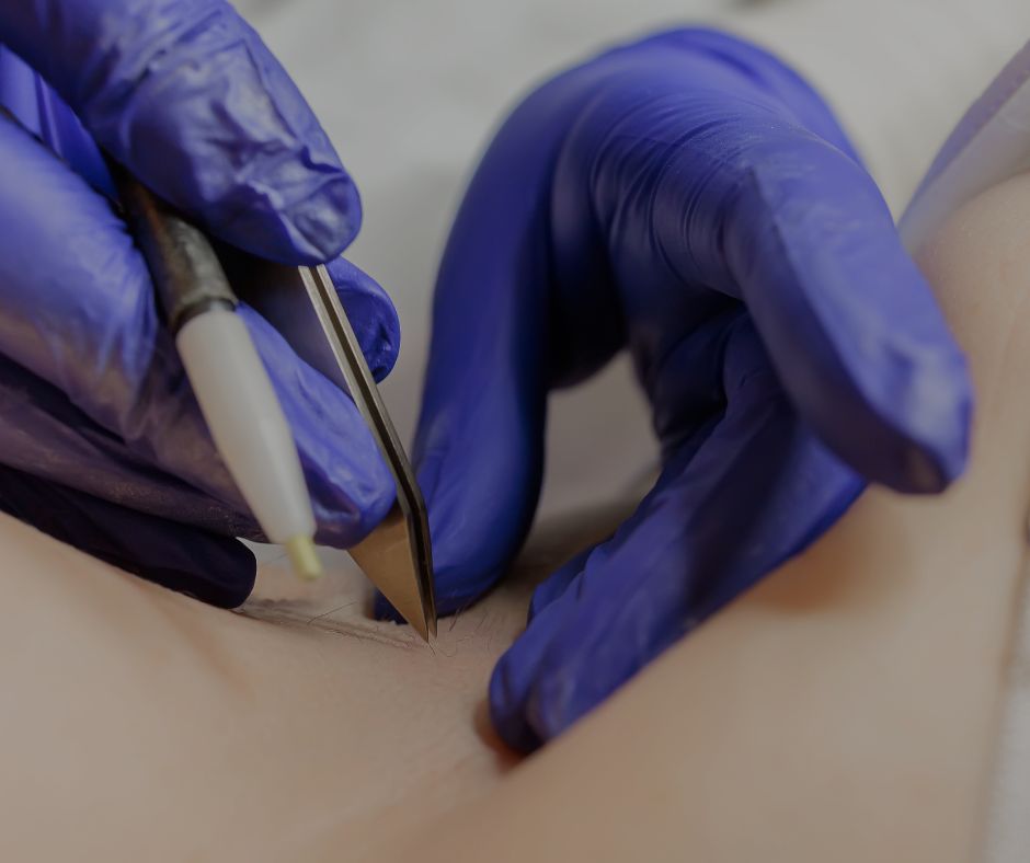 Laser Hair Removal vs. Electrolysis: Which Is Better?