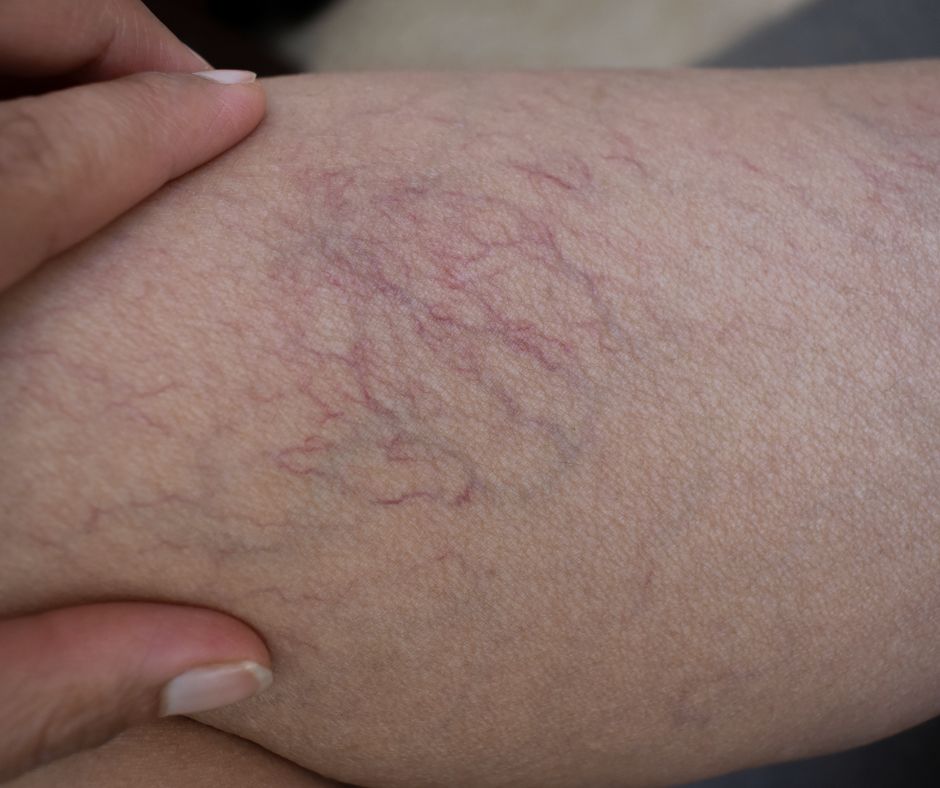 Spider Veins Removal Sparkle Lifestyle MediSpa Moncton