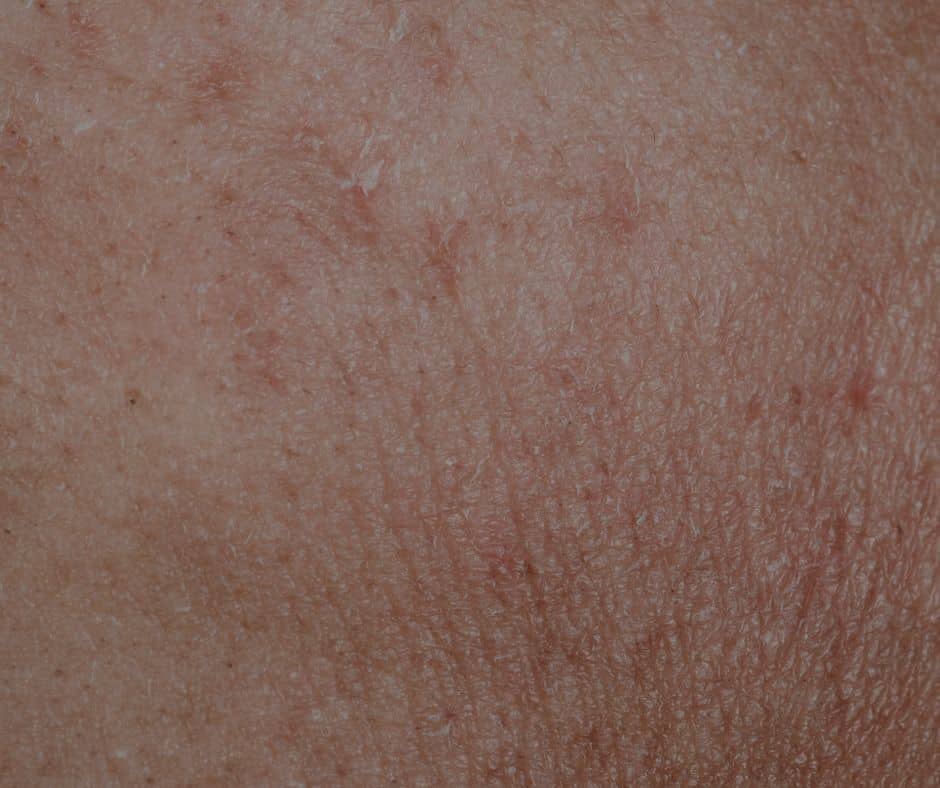Uneven Skin Texture Treatment in Moncton